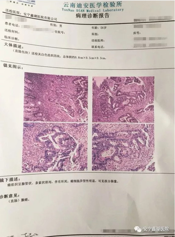 这种癌症一旦病发都是中晚期,做胃镜就可以早点发现,及时治疗